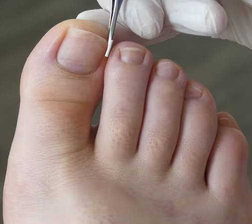 Imagen de Uña Encarnada